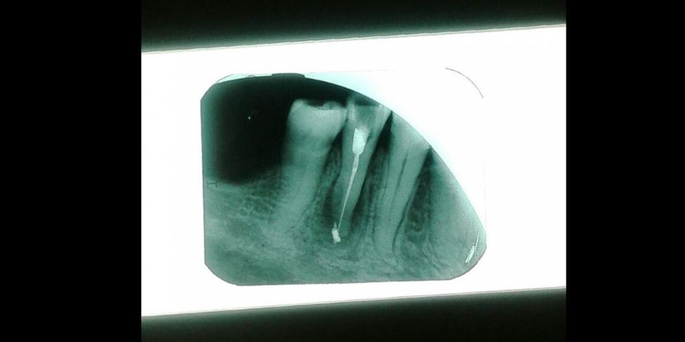  Лечение каналов корня зуба