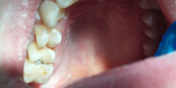 Лечение кариеса четырех зубов подряд фото до лечения