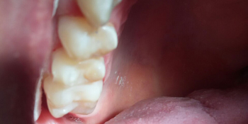 Лечение кариеса четырех зубов подряд фото после лечения